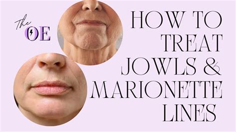 At Glance. . Facial exercises for jowls and marionette lines